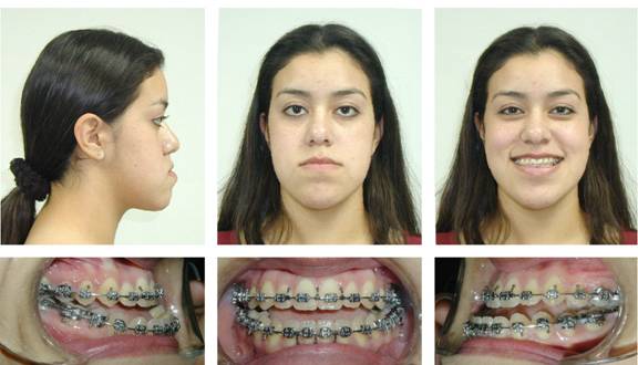 Patient #4 Prior to orthognathic surgery