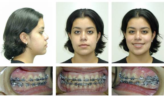 Patient #4 After orthognathic surgery