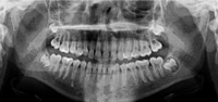 Panoramic X-ray