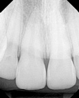 Periapical X-ray